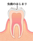 初期の虫歯