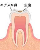 エナメル質の虫歯