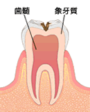 象牙質の虫歯