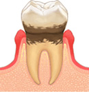 初期の歯周病