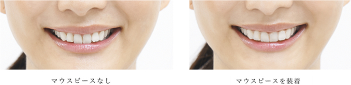 マウスピース装着時画像