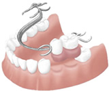 部分入れ歯のイメージ